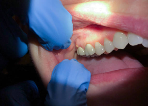 Best Emergency Tooth Extraction in Sherrelwood, CO