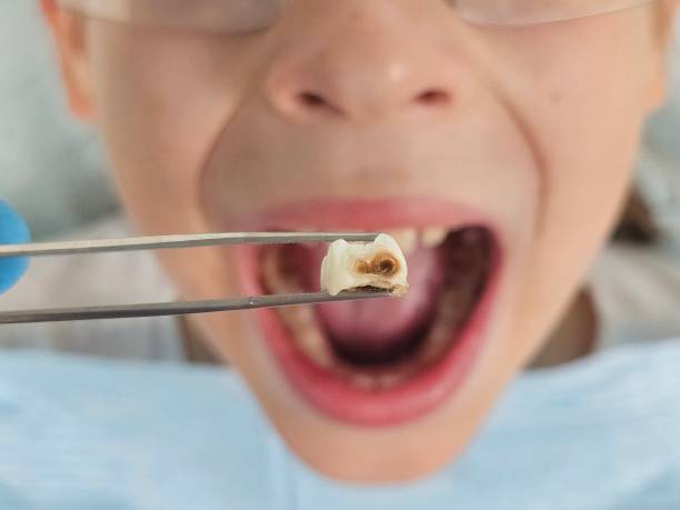 Best Emergency Root Canal Treatment in Sherrelwood, CO